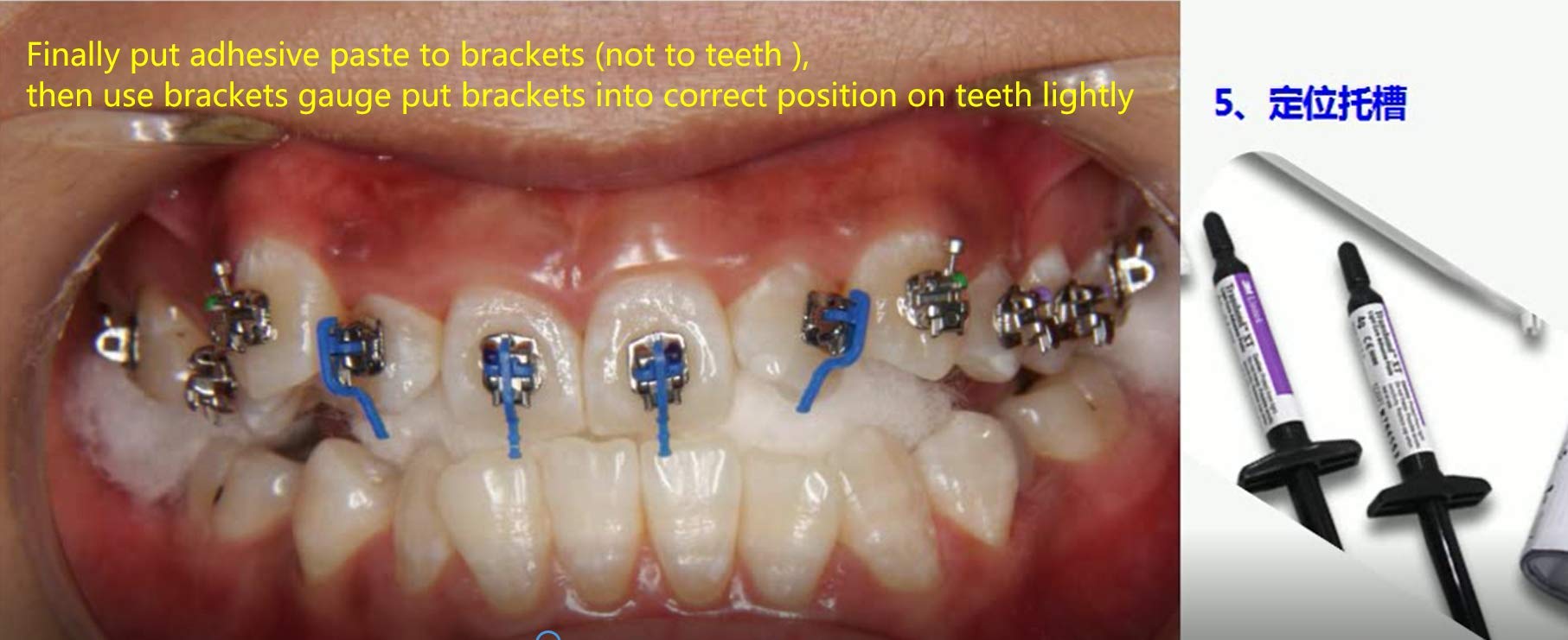 Sino Dental Orthodontic Brackets Glue Braces Bonding Light Cure