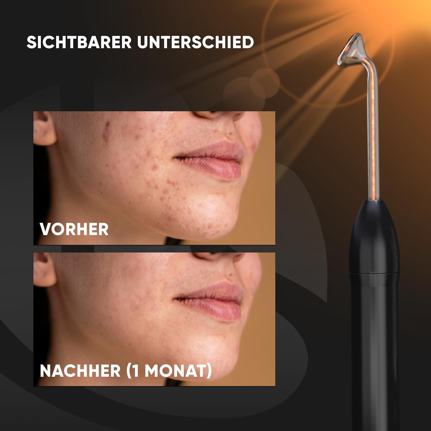 DARSONVAL Premium: Hautverjüngung, Haarregeneration, Aknebehandlung, Faltenreduktion, Physiotherapeutisches Gerät, Hochfrequenz Gesichtsgerät (Schwarz)