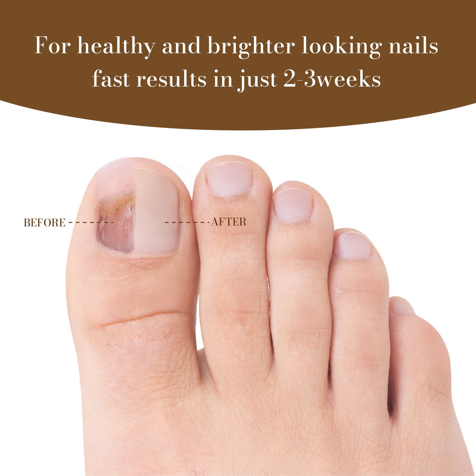 Fungal Nail Treatment for Toenails & Fingers, Nailtroe Toenail Fungus Treatment Nail Strengthener and Repair 10ml - Image 4