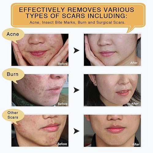 Miniatura 3 de Paquete de 3 cremas para eliminar cicatrices, crema de cicatrices TCM para cicatrices quirúrgicas, crema para el cuidado de la piel del acné, crema