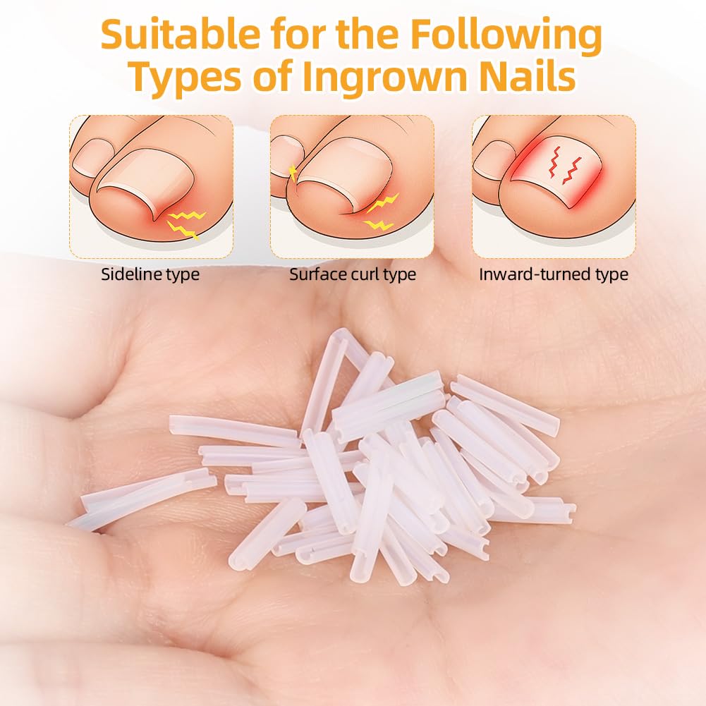 Beugo Set Correttore per Unghie Incarnite, 110 cerotti correttivi autoadesivi per unghie dei piedi, 50 pezzi Strisce raddrizzanti per unghie incarnite senza dolore con sollevatore per unghie