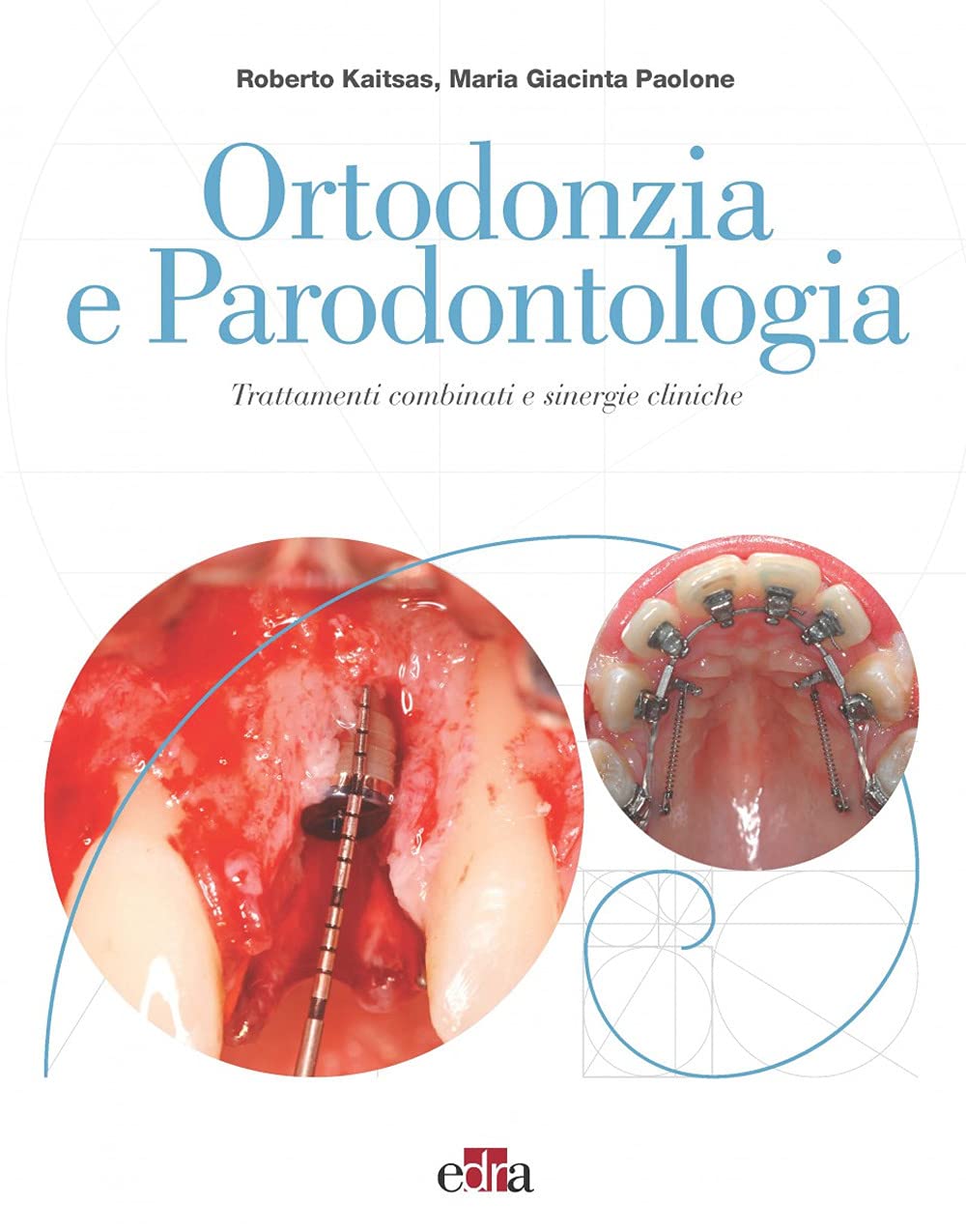Ortodonzia E Parodontologia. Trattamenti Combinati E Sinergie Cliniche - 4