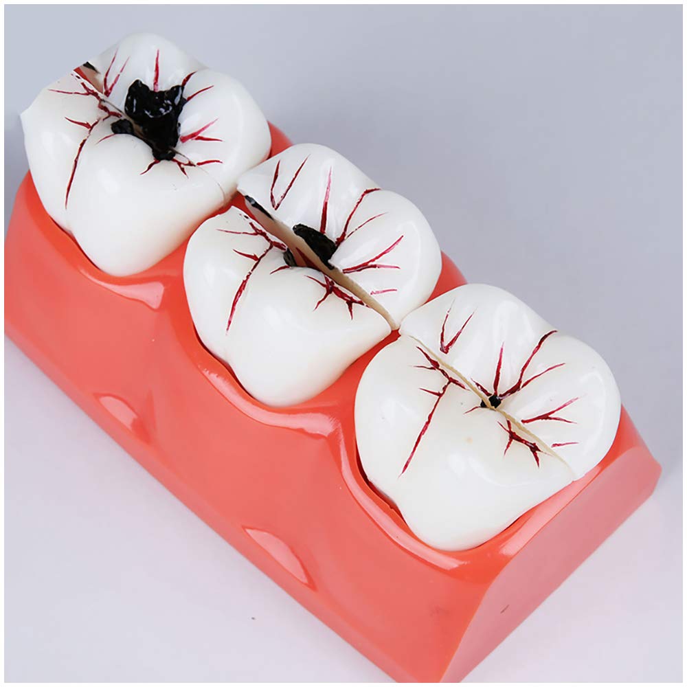 sjdoPulse Teeth Teaching Model - 4X Caries Teeth Decomposition Model Simulation Oral Tooth Caries Teeth Decomposition Mode - Demonstrate The Three Stages of Caries Development (A)