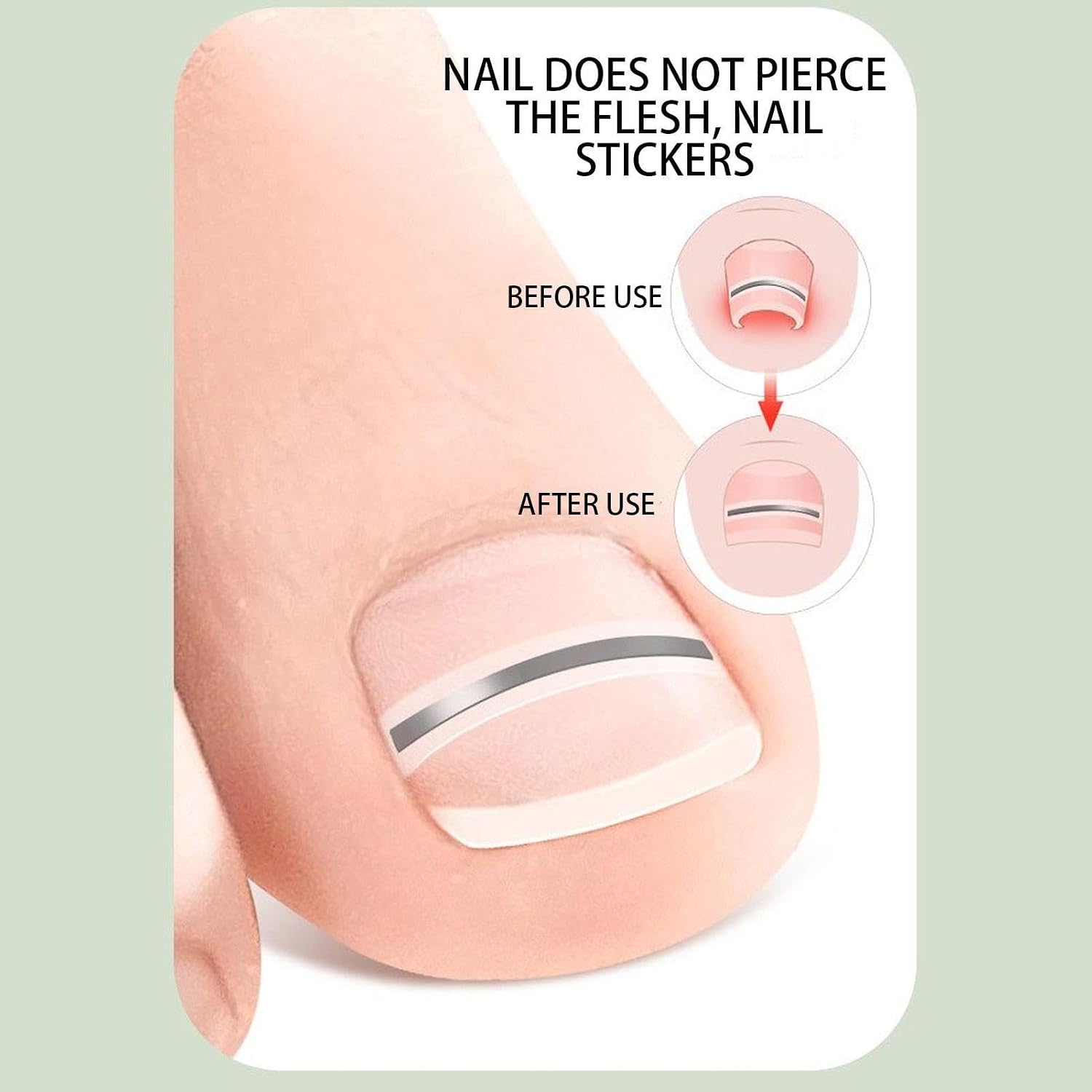 Correction Patches for Nails 10 Piece Nail Correction Patches Ingrown