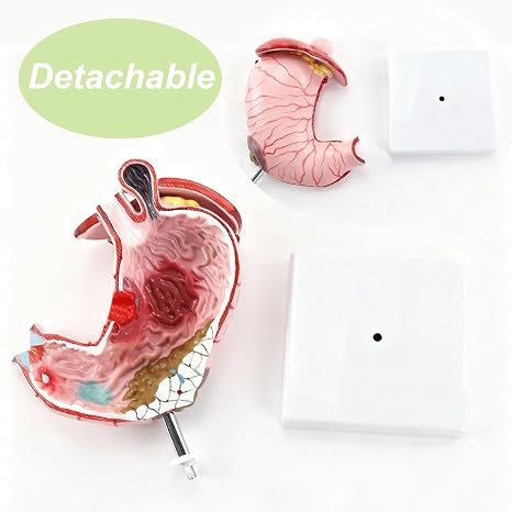 Human Pathological Stomach Model with Base, Detachable Anatomical Model for Gastric Ulcer Chronic Atrophic Gastritis Demonstration, Stomach Lesion Visual Aid Tool