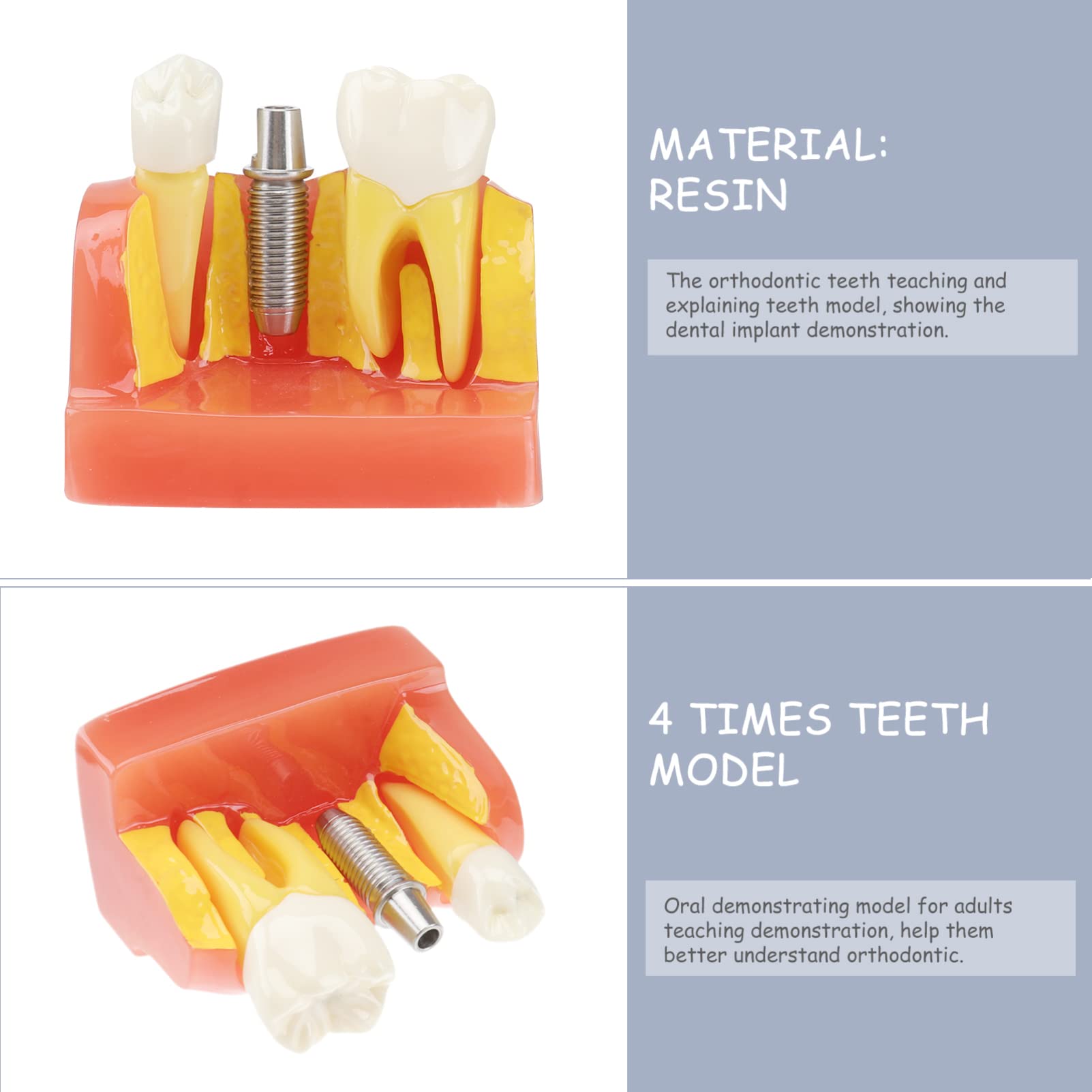 OUNONA 1pezzi Modello di Denti Didattico Rimovibile per Strumento Educativo per Lezioni di Odontoiatria Modello di Studio con Denti e Protesi
