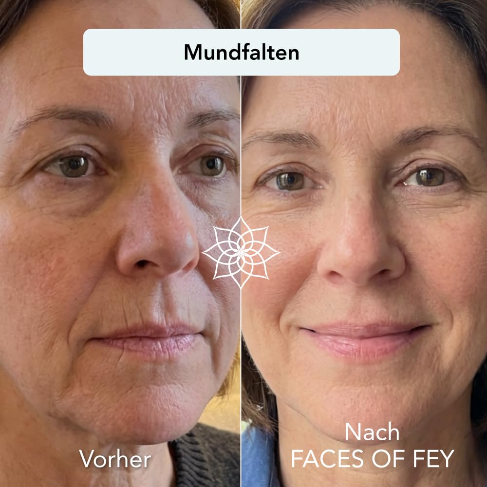 Dermaroller 0,5mm ECHTE Nadeln - Microneedling Anti Aging System 1 Monat - gegen Falten & schlaffe Haut - Zornesfalte, Strinfalten, Augenfalten, Nasolabialfalten, Mundfalten - FACES OF FEY