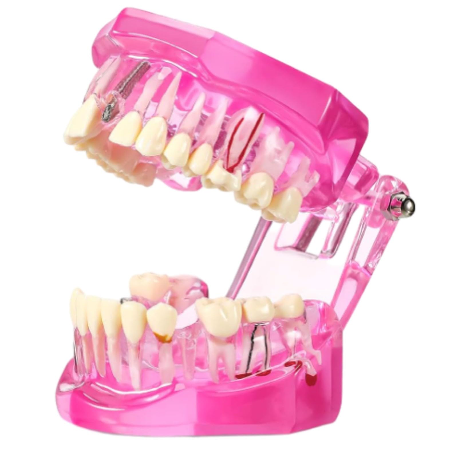 Xiaoxu Modello di Denti patologici, Modello di Denti implantari Trasparenti con Denti Rimovibili per Studio e didattica odontoiatrica.
