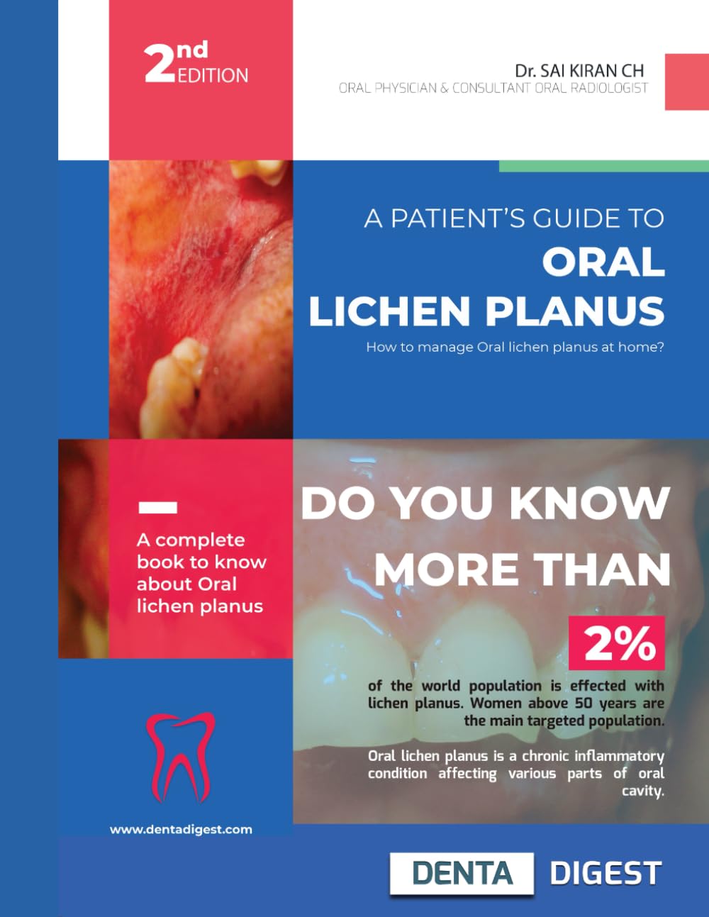 A Patient's Guide to Oral Lichen planus