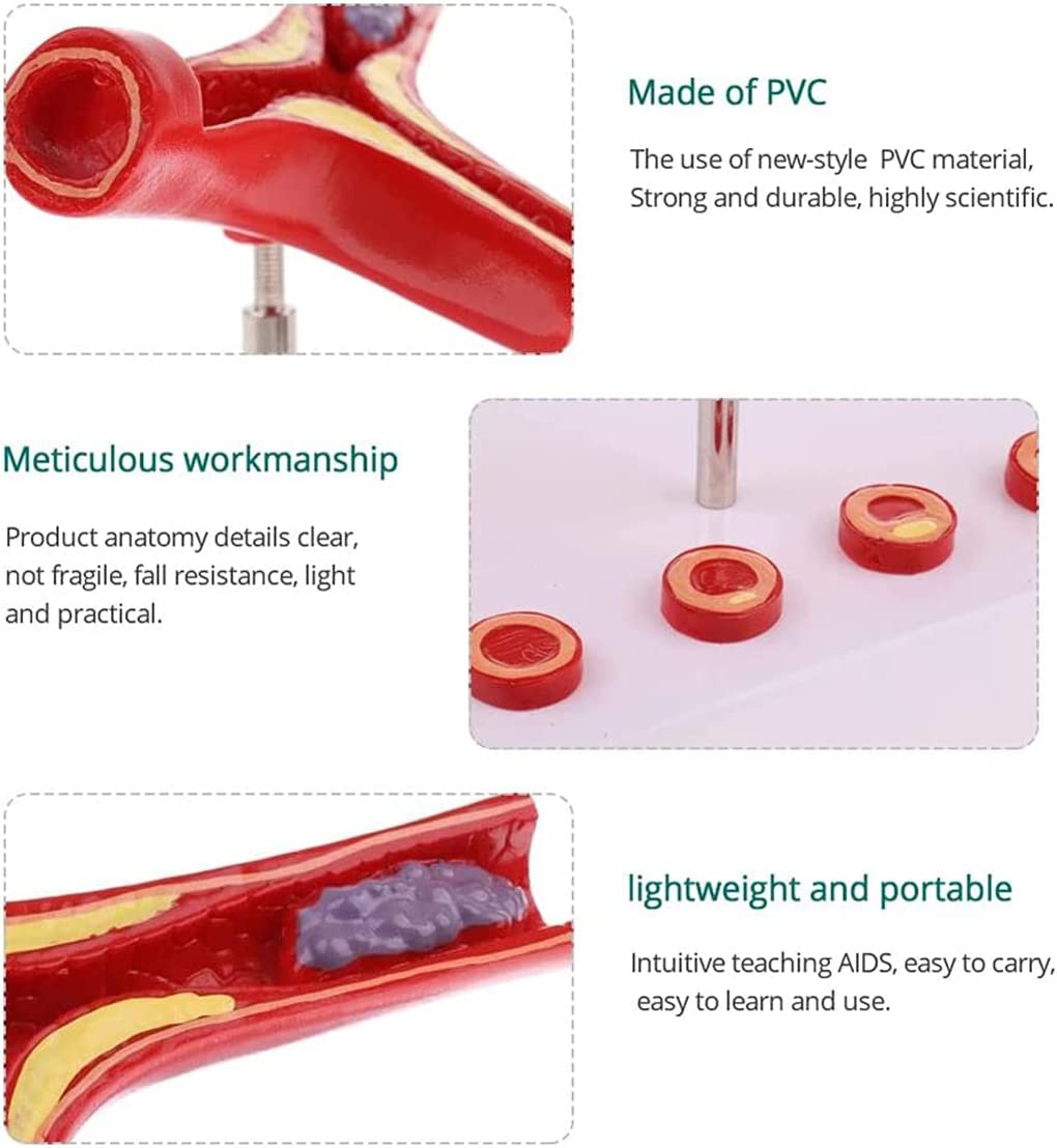 Modèle de Thrombus athéroscléreux vasculaire Humain avec Base Modèle pathologique cardiovasculaire Modèle médical Matériel pédagogique
