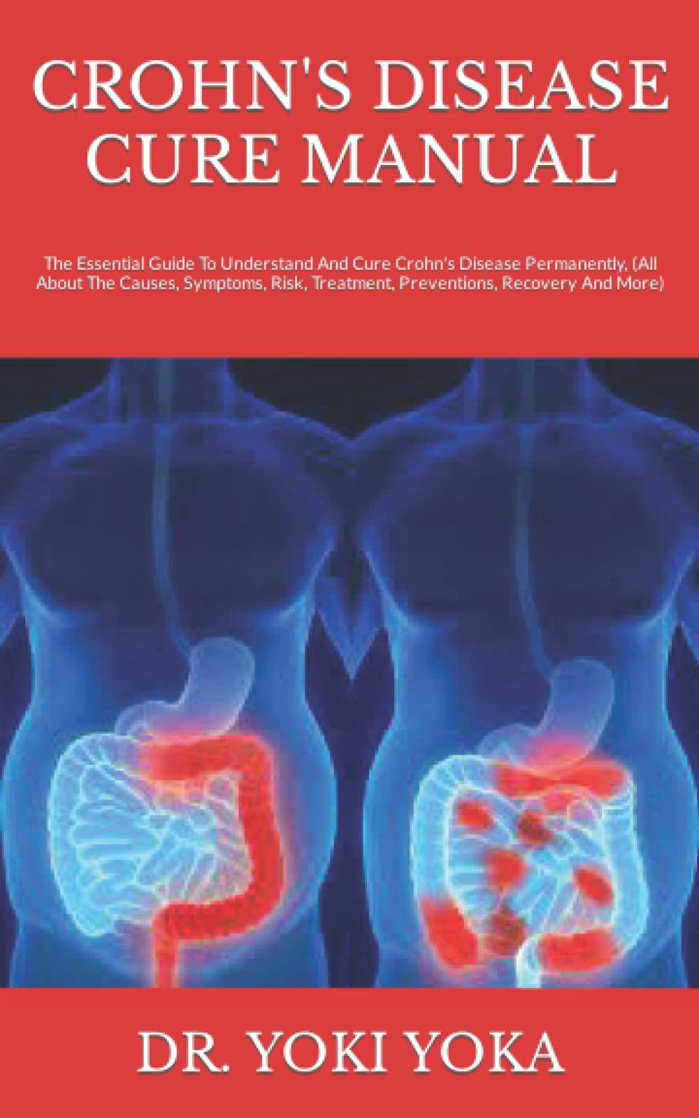 Buy CROHN'S DISEASE CURE MANUAL The Essential Guide To Understand And