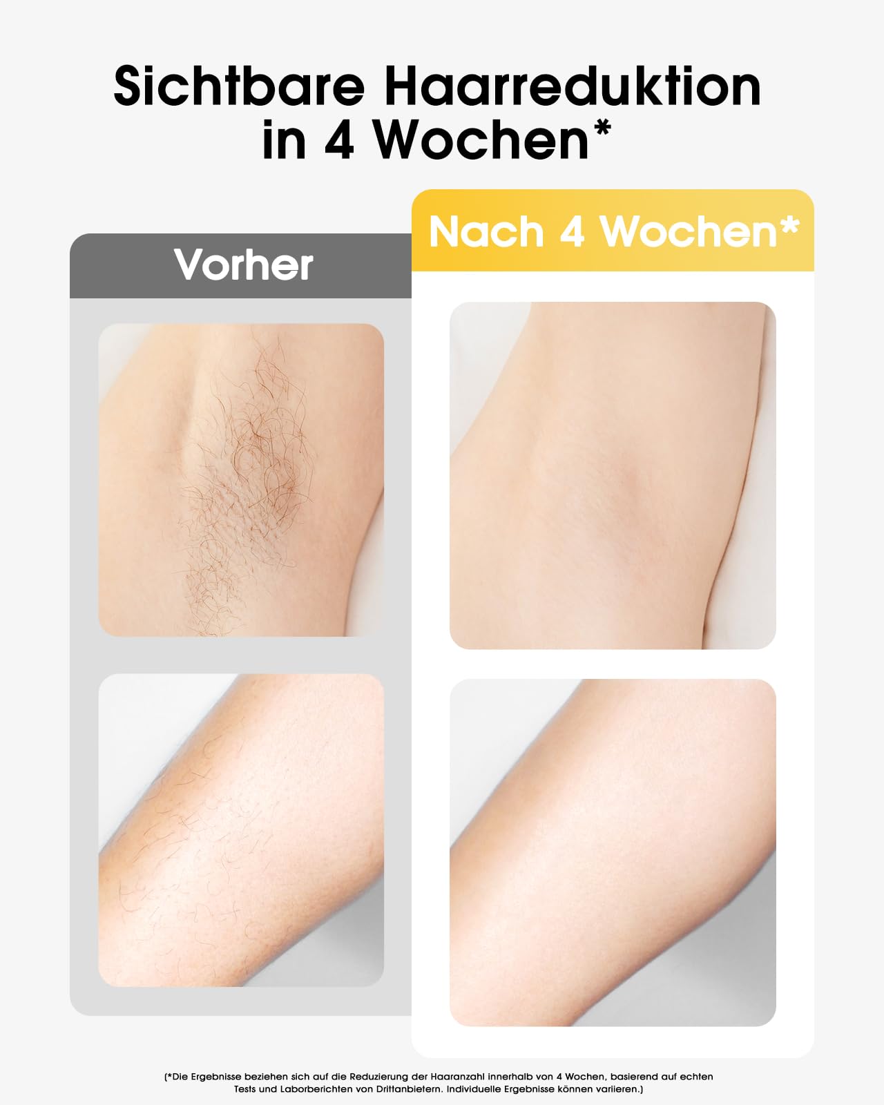 Haarlosy IPL Geräte Haarentfernung mit Kühlfunktion, 999,900 Lichtimpulse, 5 Energiestufen Schmerzfreie IPL Haarentfernung Laser Hair Removal für Frauen, Männer, Bikini, Körper und Beine