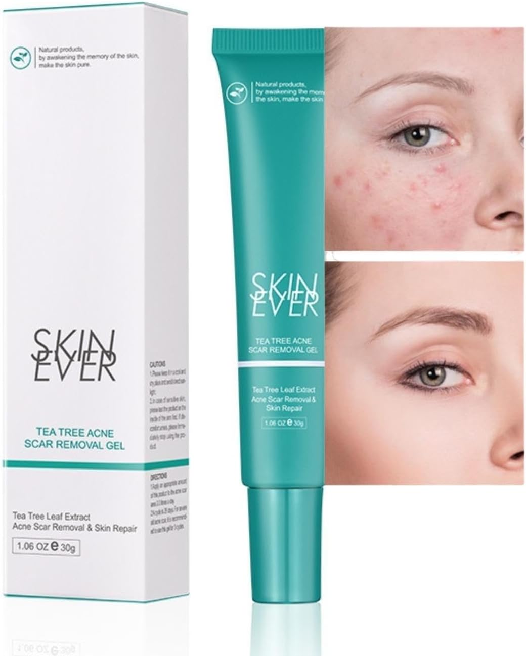 JDLYEVER Tea Tree Acne Gel Lightens Acne Marks & Repairs Acne Skin, Tea Tree Infused Fades Acne Scars Repairs and Nourishes, Lightweight and Non-Greasy Deep Penetrating Formula Easy to Apply 30ML