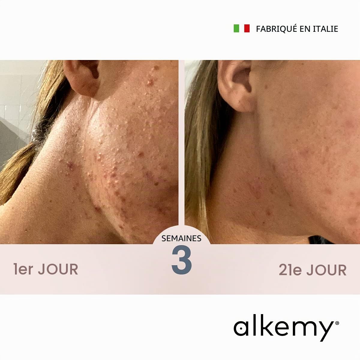 ALKEMY Crème Anti Boutons Visage, forte action Apaisante, Purifiante et Anti Tache - Réduit rapidement les Imperfections et l’ Acne, Cosmétique Naturelle, Testé Dermatologiquement – PURIFYNG CREAM