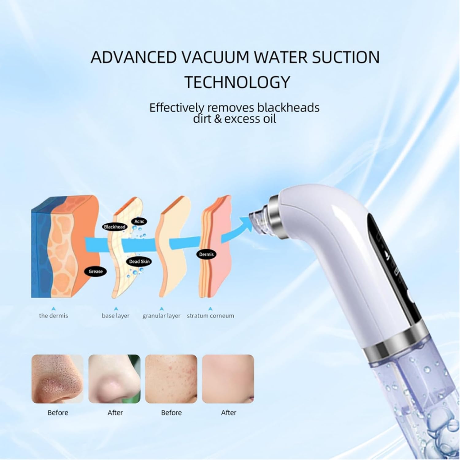 جهاز إزالة الرؤوس السوداء بشفط كهربائي مع 3 مستويا...