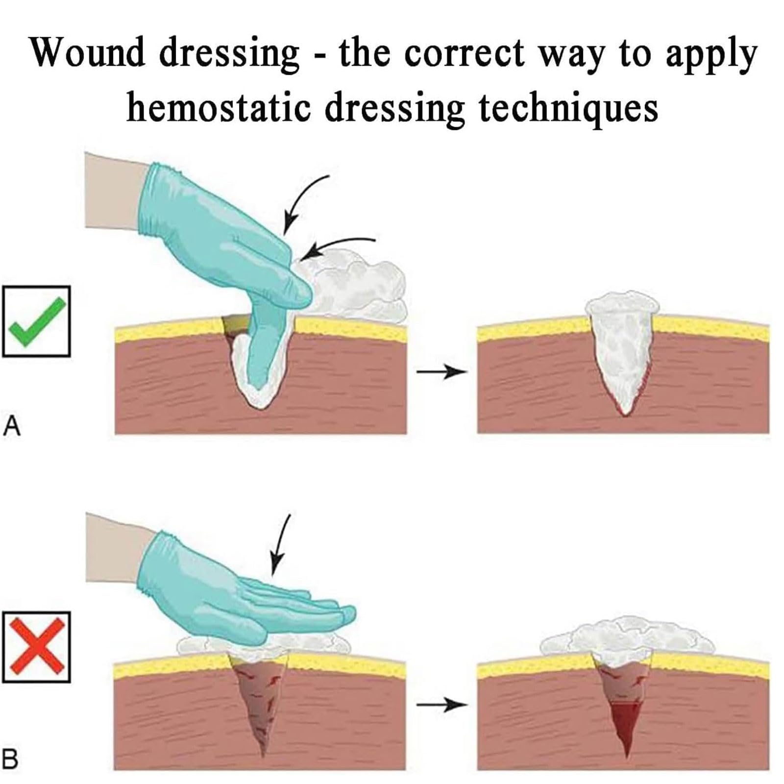 Modelo de Silicona para Entrenamiento de heridas en el Muslo, para el Control de Sangrado y empaquetamiento de heridas, Ayuda para el Entrenamiento de Vendajes hemostáticos, para capacitación