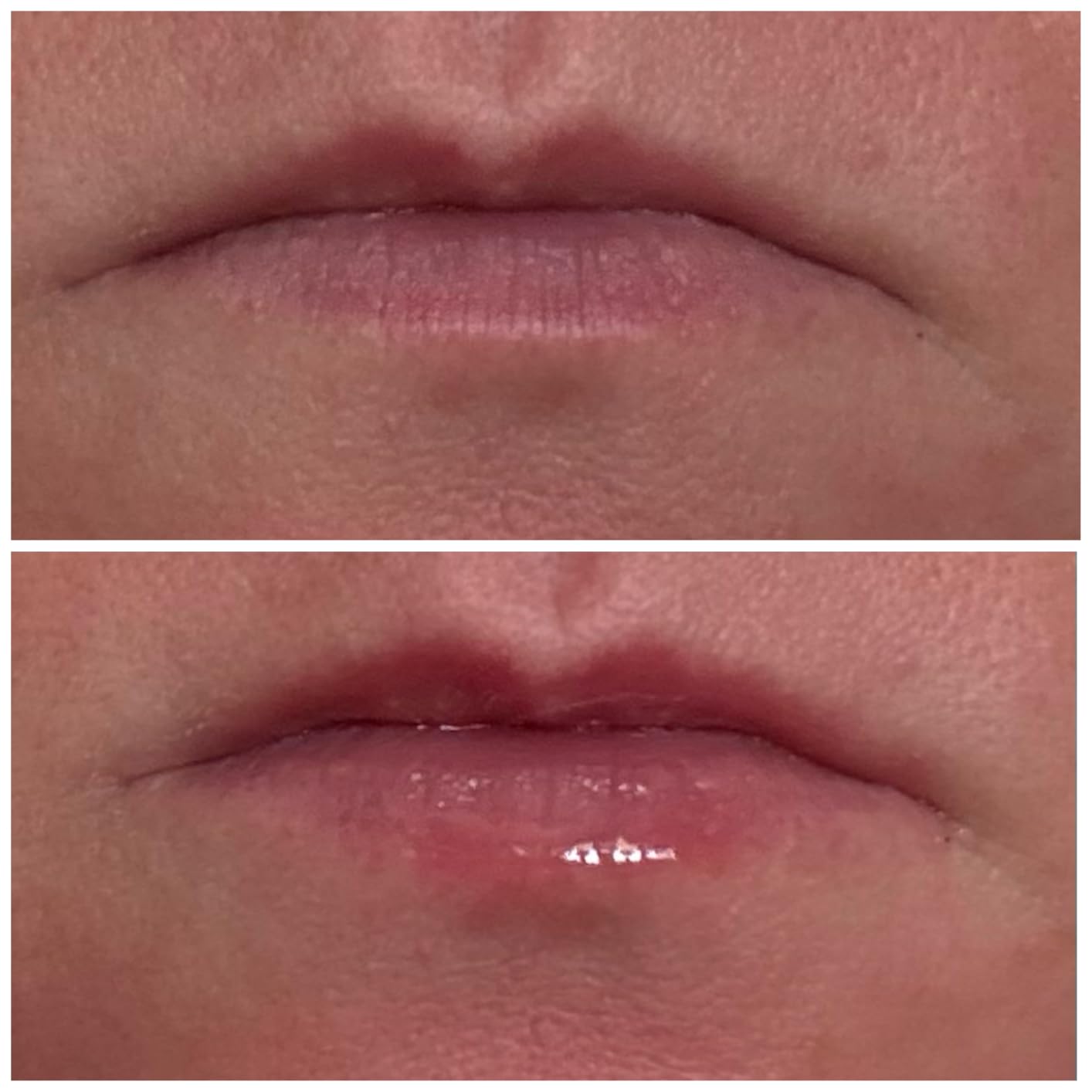 VT COSMETICS Reedle Shot Lip Plumper, Hydrating & Volumizing Clear Lip Gloss, Microneedling Effect & Hyaluronic Acid for Fuller, Smoother Lips, 0.15 oz (4.3 g) (Beginner)