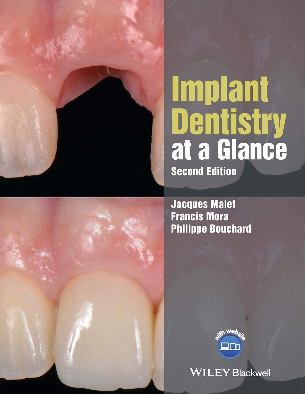 Implant Dentistry at a Glance by Jacques Malet, Francis Mora, Philippe ...