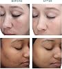 TCATherapy Care Solution Face Peel,40% Level 2, pH 1.9, Exfoliating Treatment, 30ml