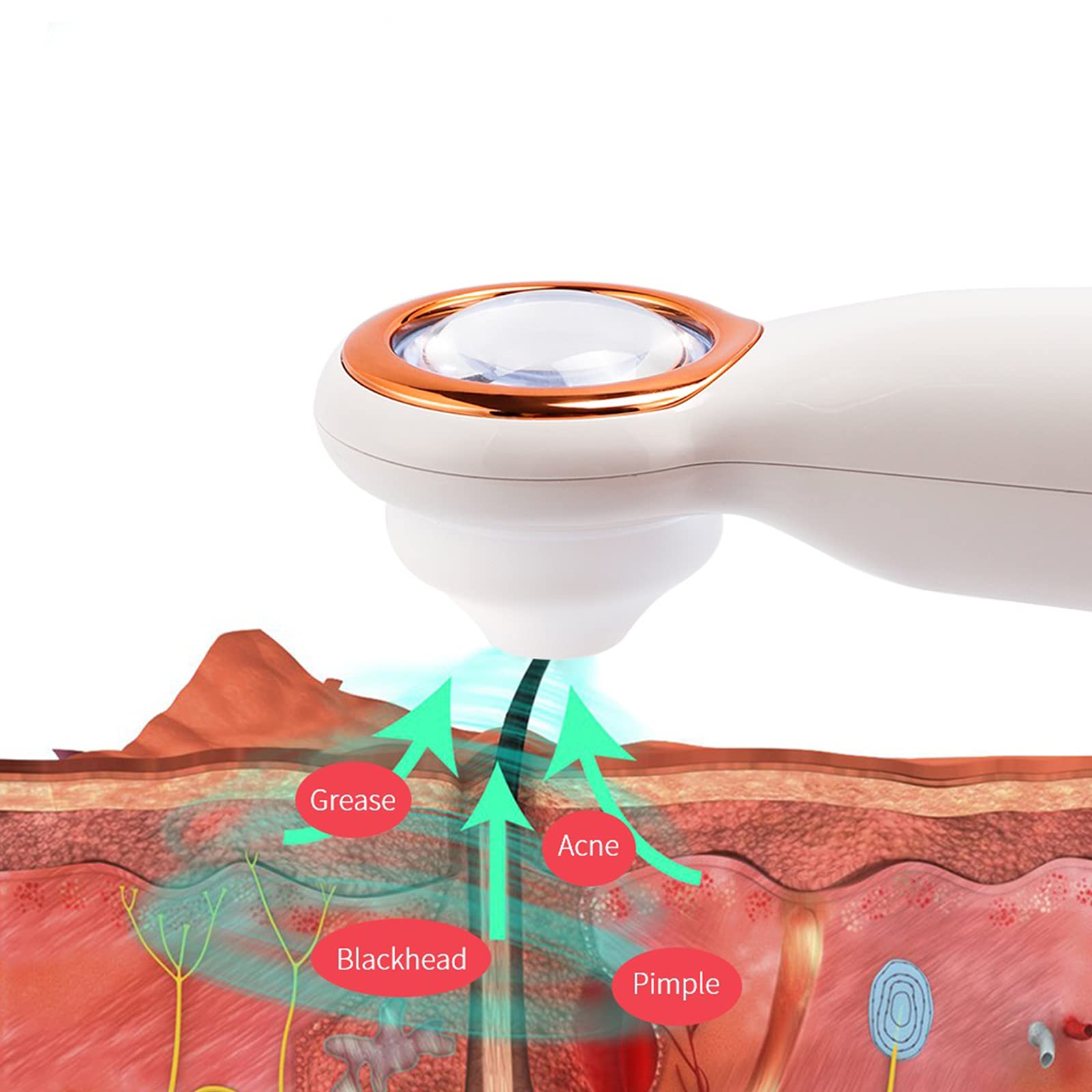 Blackheads Magnified