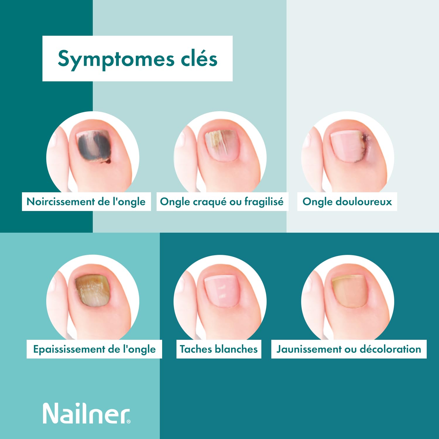 Nailner Stylo 2 en 1contre infections fongiques des ongles 4 ml - Stylo antifongique contre les mycose des ongles des mains et pieds - Résultats en 7 jours - Prévient mycoses des ongles sans limage