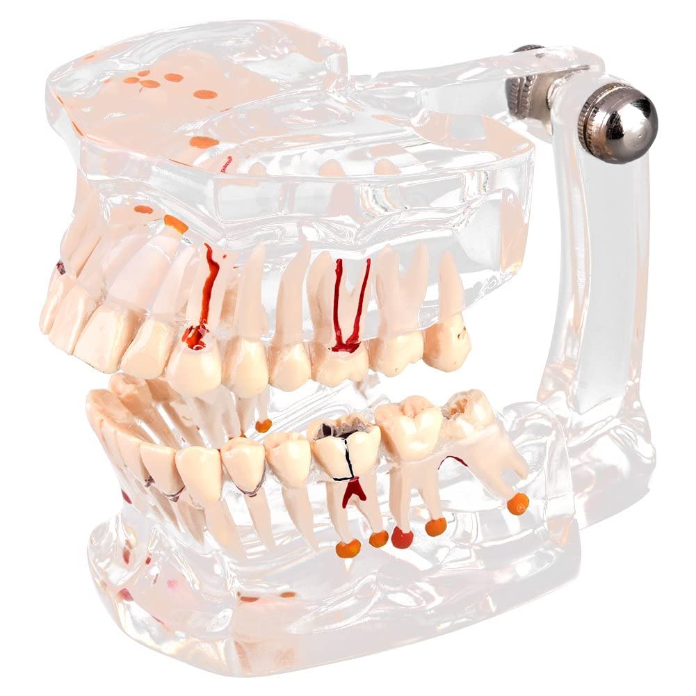 Walfront Modèle de Dents Amovibles, Transparent Dentaire Implant Disease Enseignement Étude Standard Dents Modèle Démonstration Pathologique