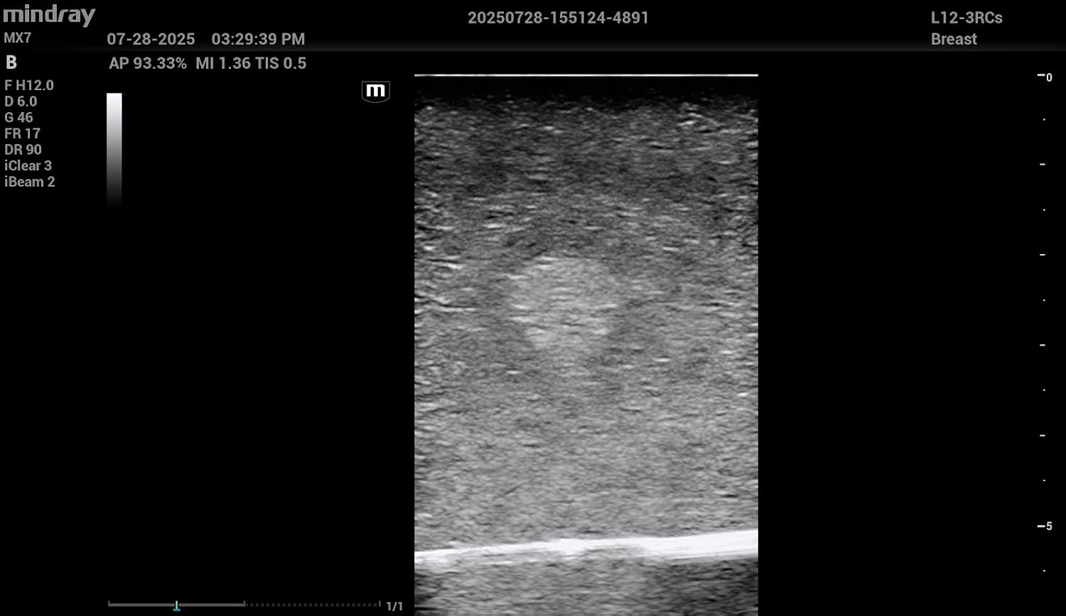 Breast Ultrasound Phantoms (Translucent)