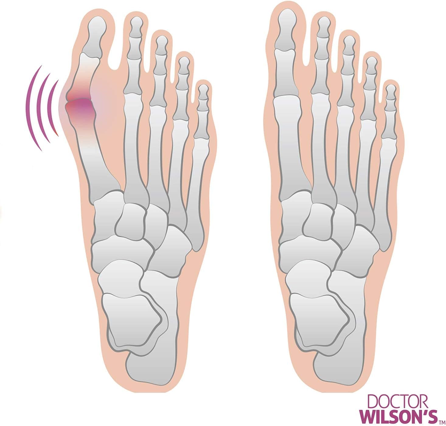 2 Bunion Relief Pads Sleeve - Bunion Splint Orthopedic Bunion Corrector Socks - Gel Pad Elastic Cushions Men and Women (1 Pair) : Everything Else