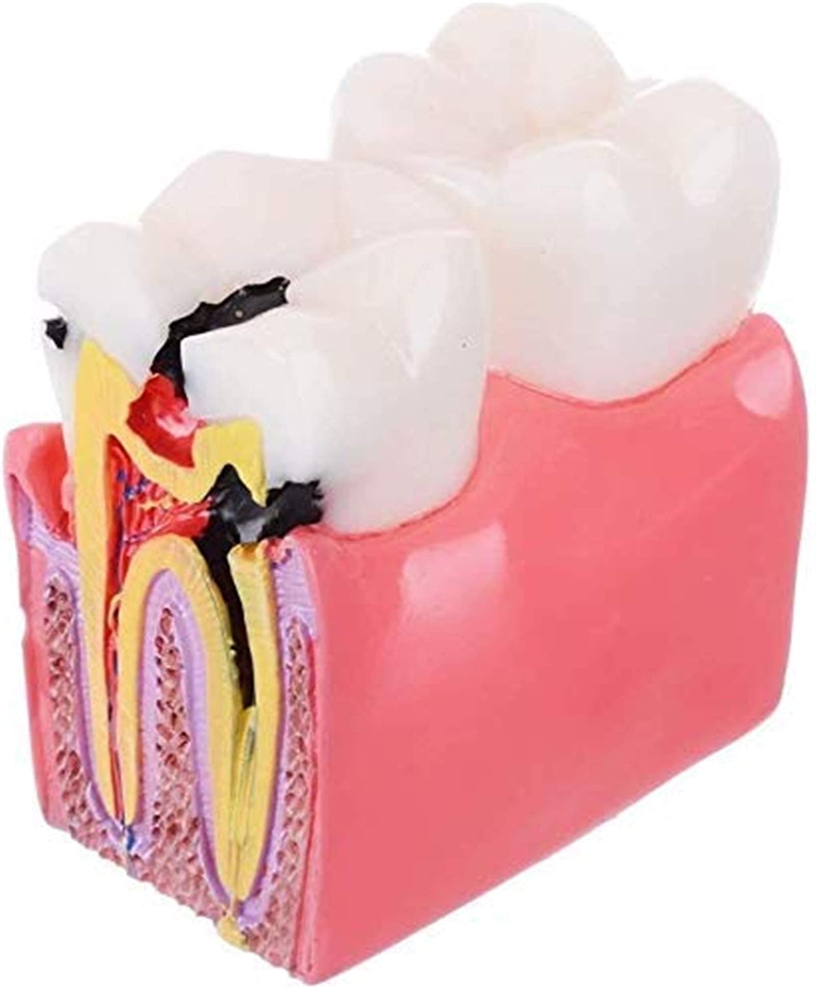 Study Model Dental Anatomy Educationaltion Teeth Model For Dentist Studying And Researching 6 Times Caries Comparation Study Models 1Pc 0827