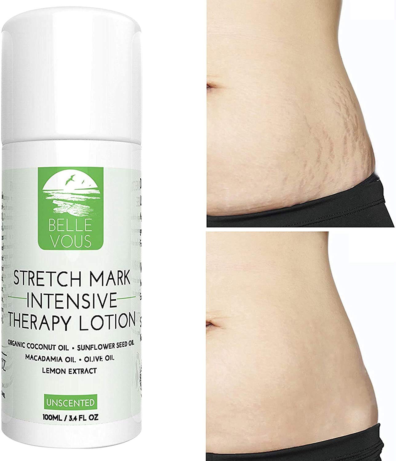 Stretch Mark Lotion 100ml Scars And Pregnancy Stretch Mark Treatment Remove Stretch Mark 