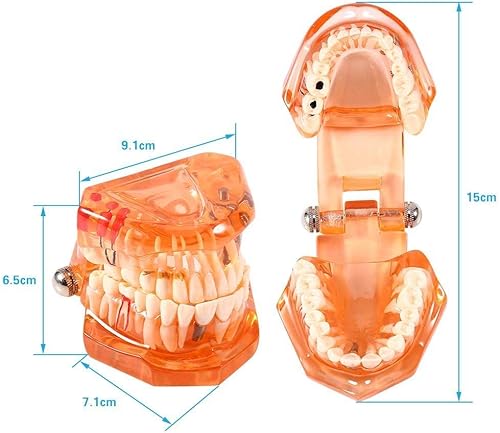 Miniatura 3 de Modelo de enseñanza de los dientes de la enfermedad dental de la enfermedad dental extraíble del color naranja para el dentista y la escuela