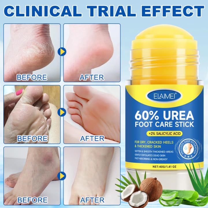 60% urea with 2% salicylic acid urea foot care stick, Moisturizer for Dry Cracked feet,knees,Elbows,Hands,Moisturizes and Hydrates the Dry Skin, Callus Remover & Skin Softner -1.41oz(1 pack)