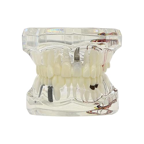 Miniatura 7 de Multifarious Tipos Modelo Dental Dientes Removibles Implante Ortodoncia Enseñanza Estudiar Modelos de demostración para Dentista Estudiante Escuela