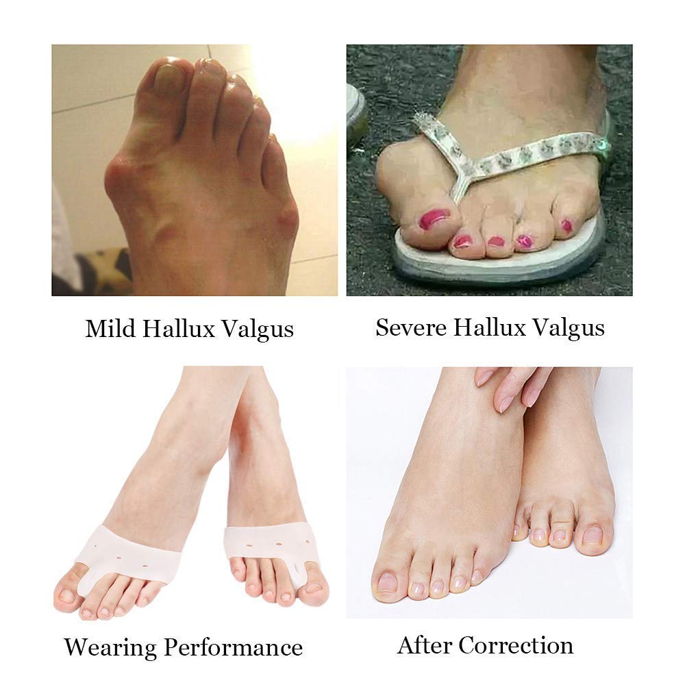 TILEZE Korrektor, Zehenglätter, bequemer Zehenspreizer aus Silikon, für Plantarfasziitis, Hallux Valgus, überlappende Zehen, 2 Stück, Tag und Nacht erhältlich