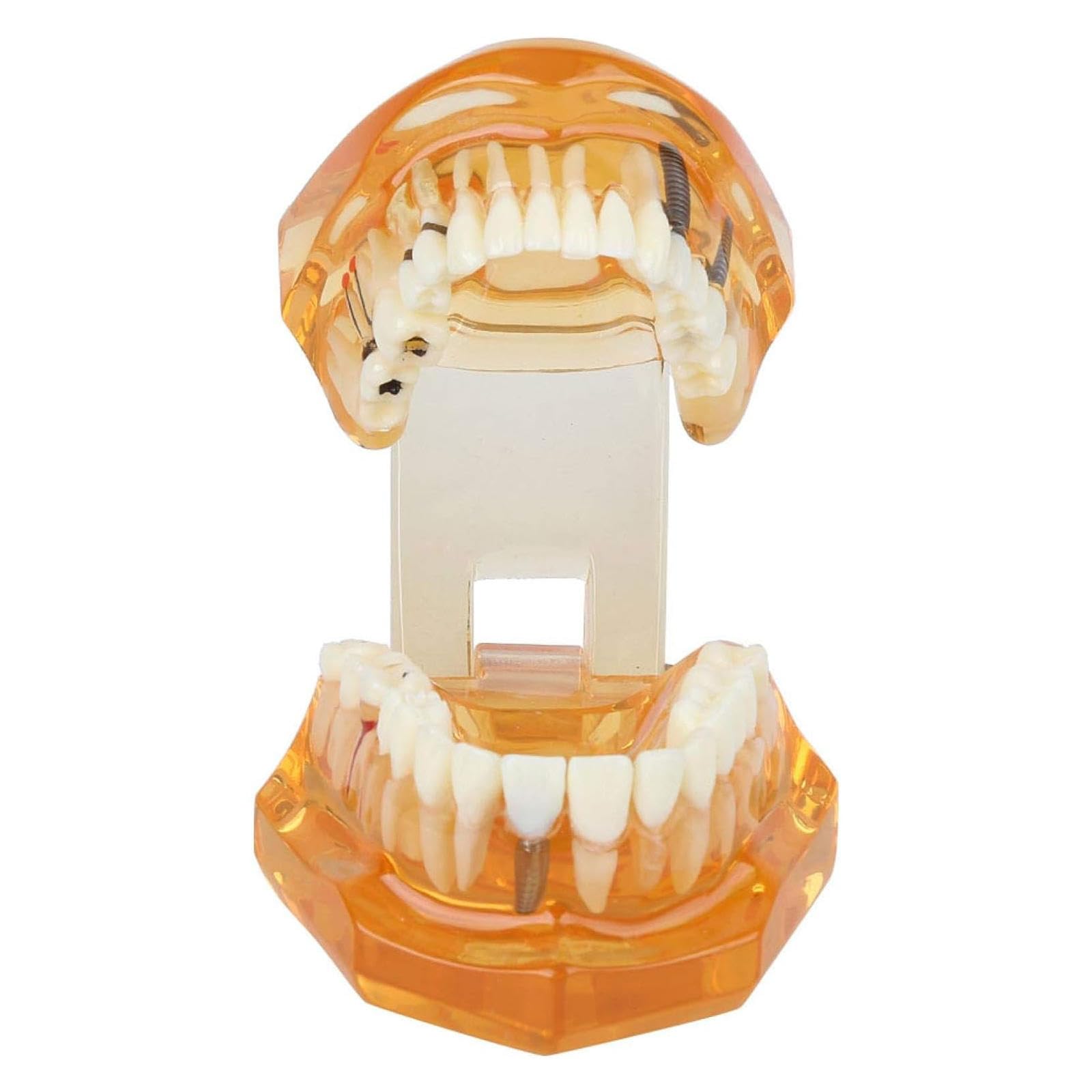 Modello di Insegnamento dello Studio Rimovibile di Malattie Dentali, Modello per Programmi Scolastici di Odontoiatria, Modello di Impianto Dentale, Strumento Dimostrativo