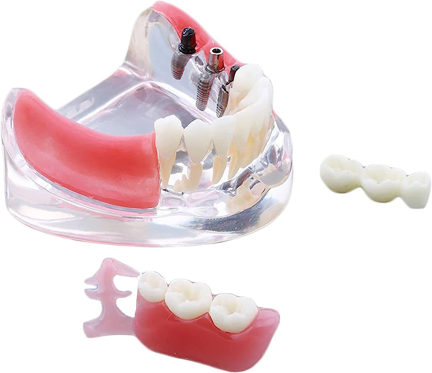 Model anatomiczny ludzkiego tułowia, Model odbudowy implantu dentystycznego do nauczania w szkołach dentystycznych z wyjmowanymi zębami