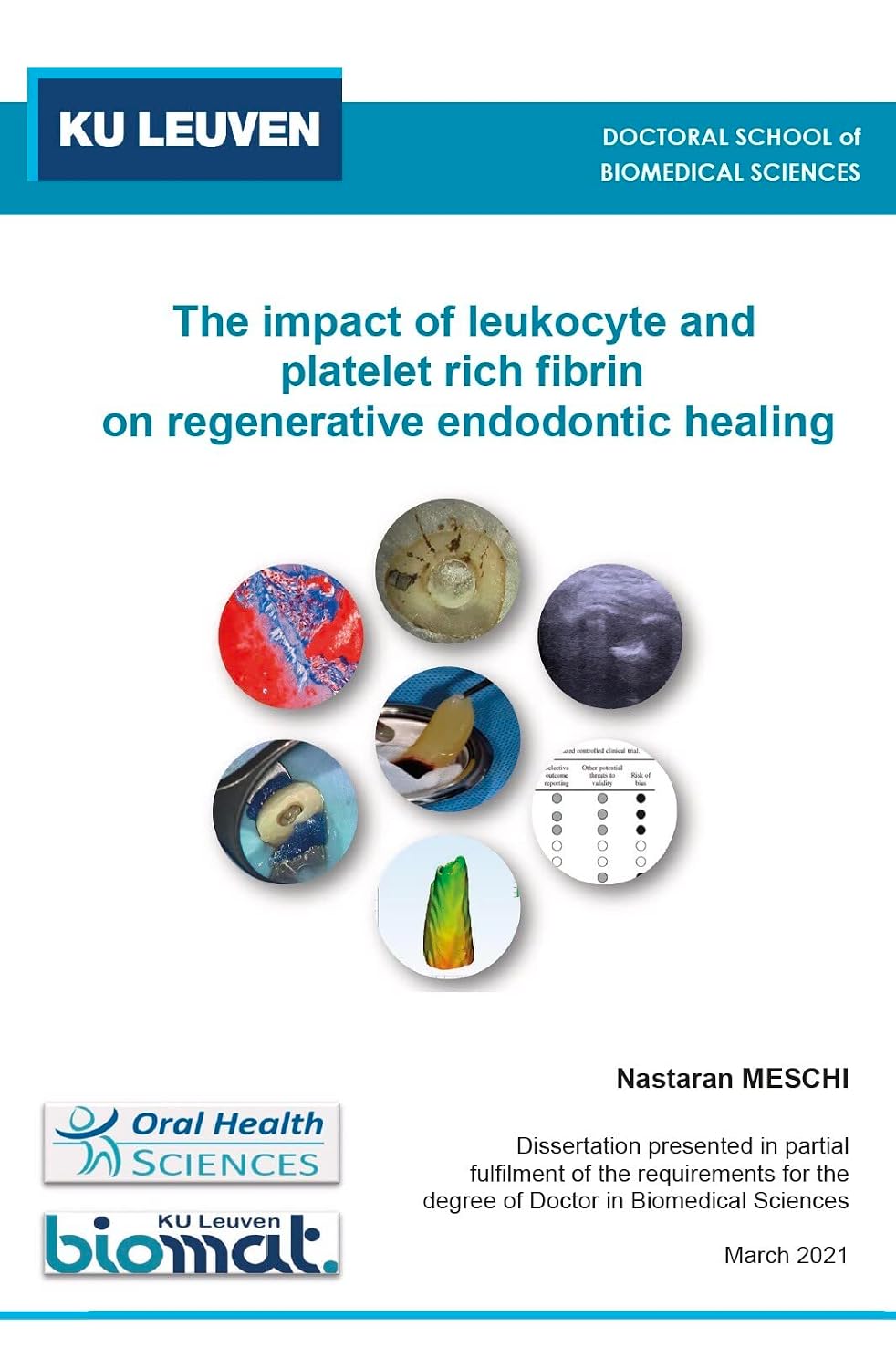 The impact of leukocyte and platelet rich fibrin on regenerative ...