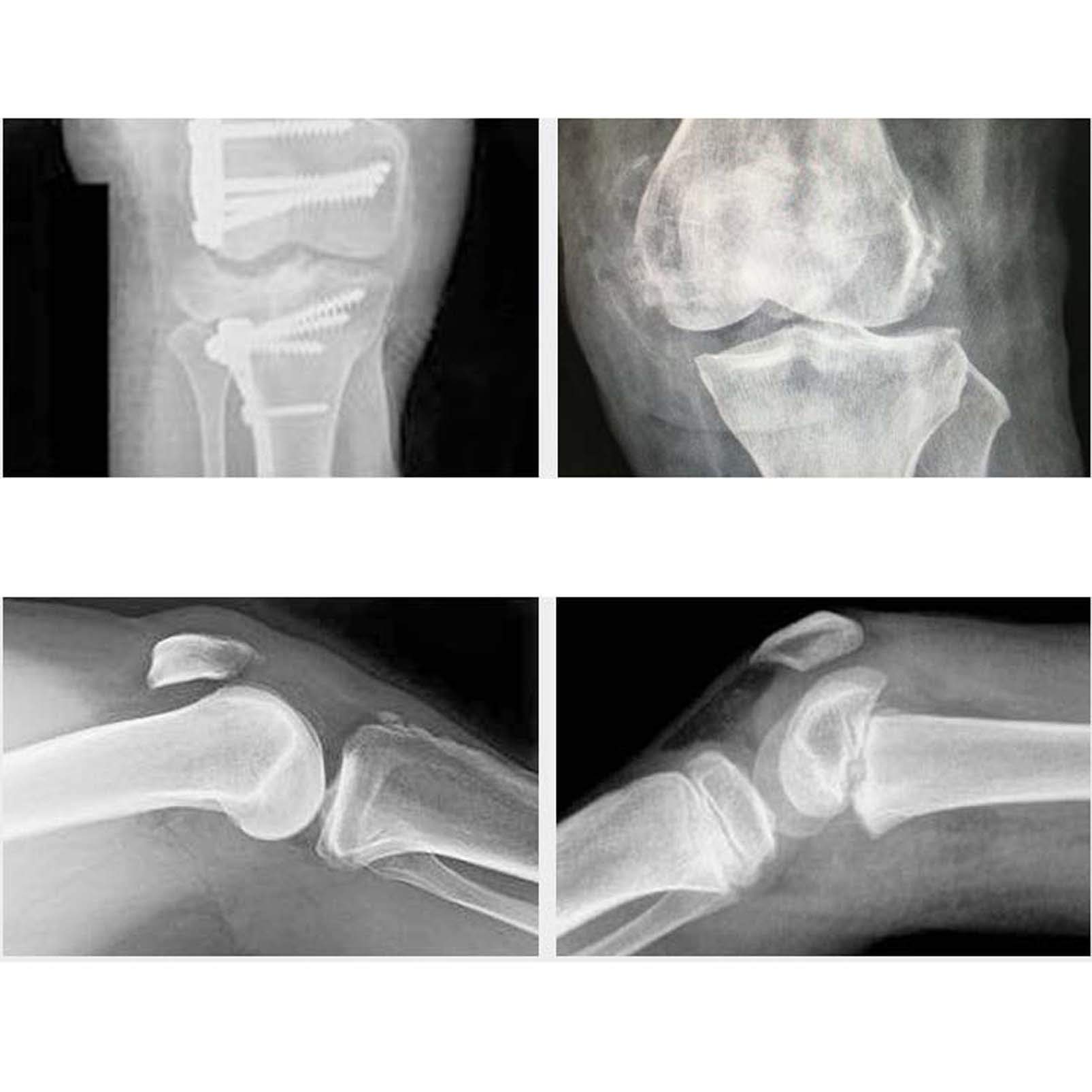 Knie-Wegfahrsperre für das ganze Bein – Unterstützung für die Erholung nach Operationen und Operationen – gerade Knieschiene – verstellbare Kompressionsbandage