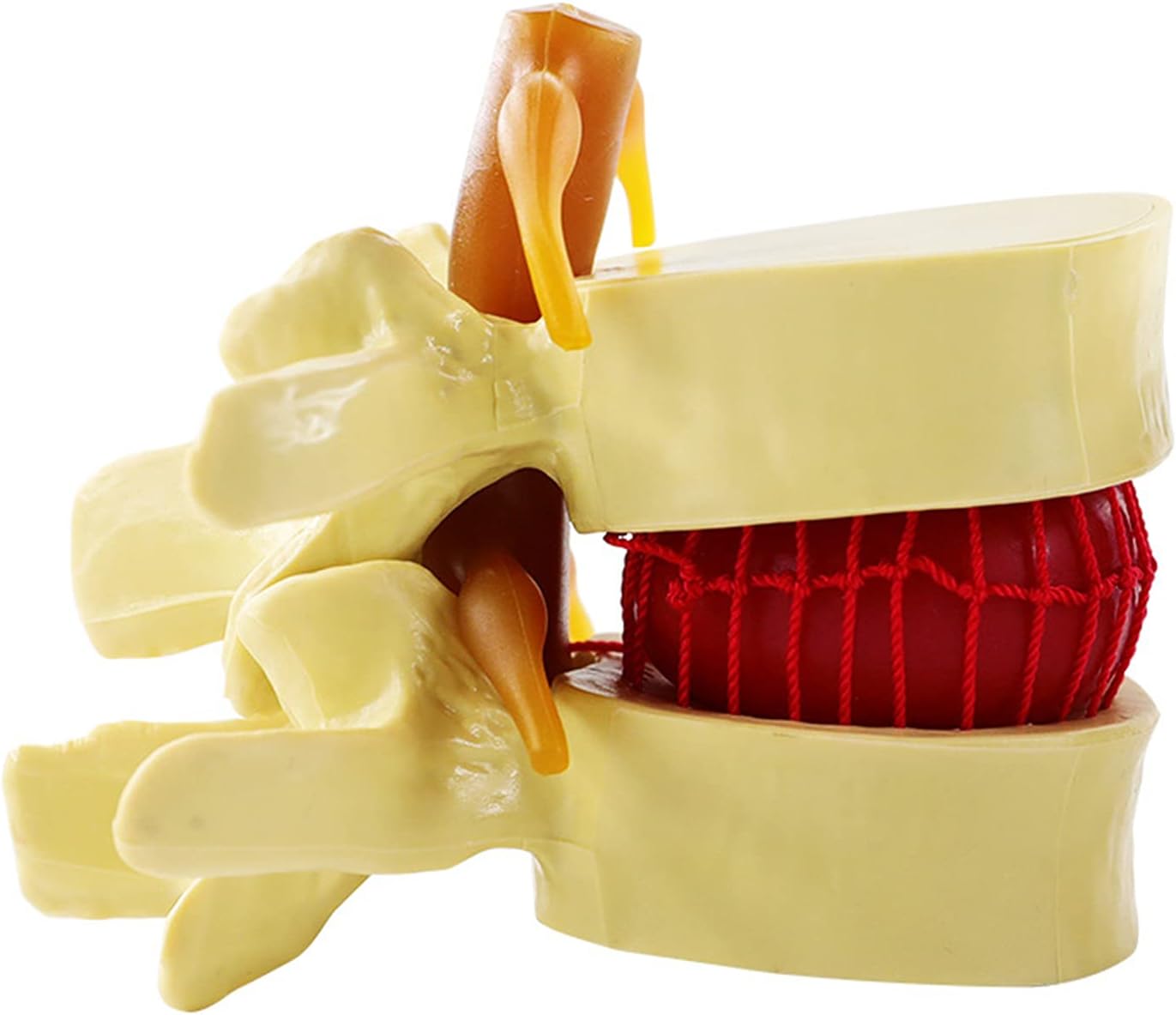 Human Lumbar Disc Herniation Model, Lumbar Disc Herniation Spine Model, Anatomical Lumbar Herniation Intervertebral Disc for School Teaching Demonstrating Lab Supplies