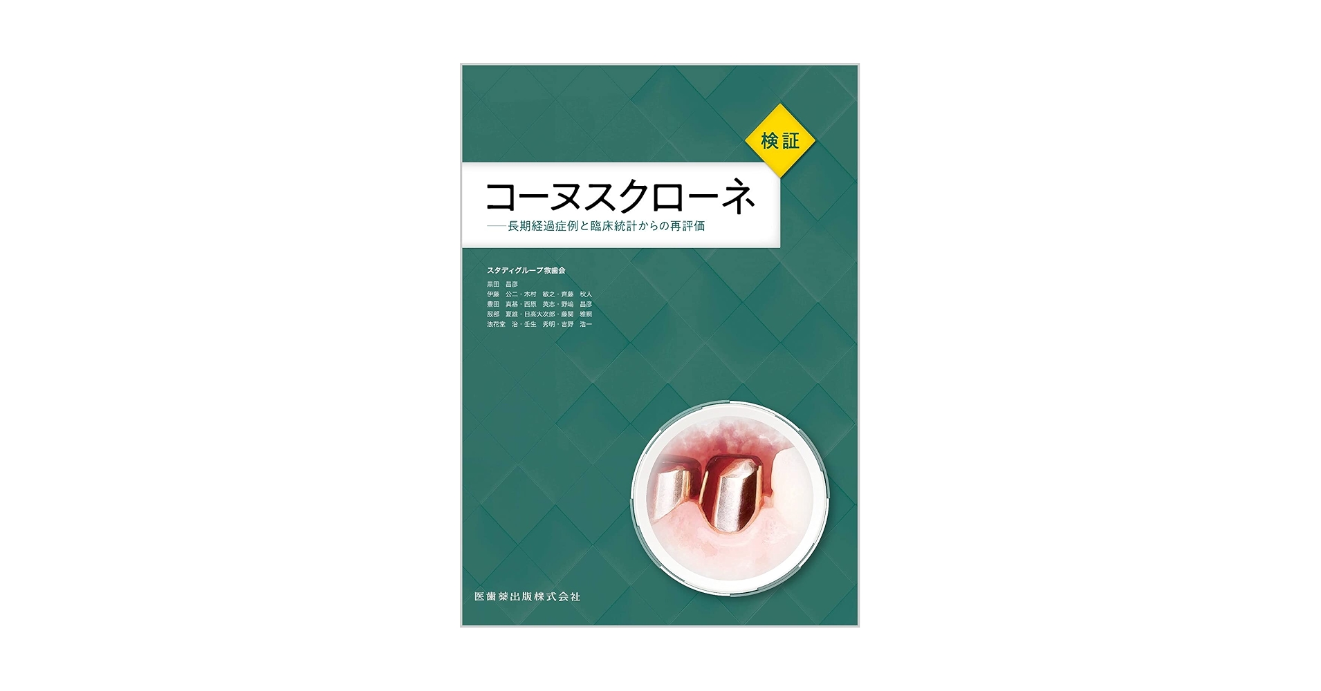 検証コーヌスクローネ : 長期経過症例と臨床統計からの再評価 Amazon.co.jp: 検証コーヌスクローネ: 長期経過症例と臨床統計