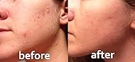 Noxzema Ultimate Clear Face Pads Clears & Prevents Acne Anti-Blemish Made with Over 60% Alcohol 90 Count