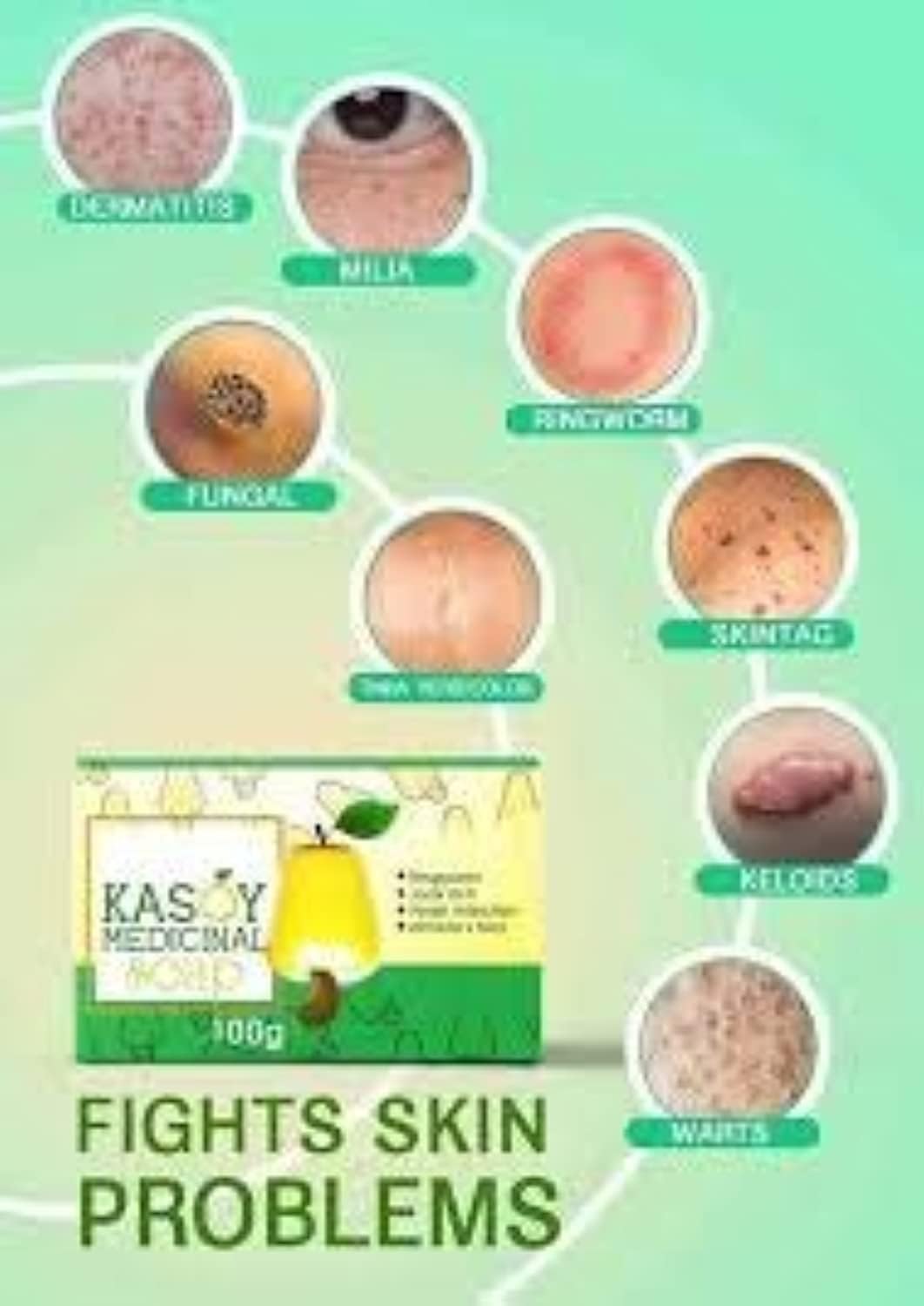 Kasoy Cream Warts Remover (10g)