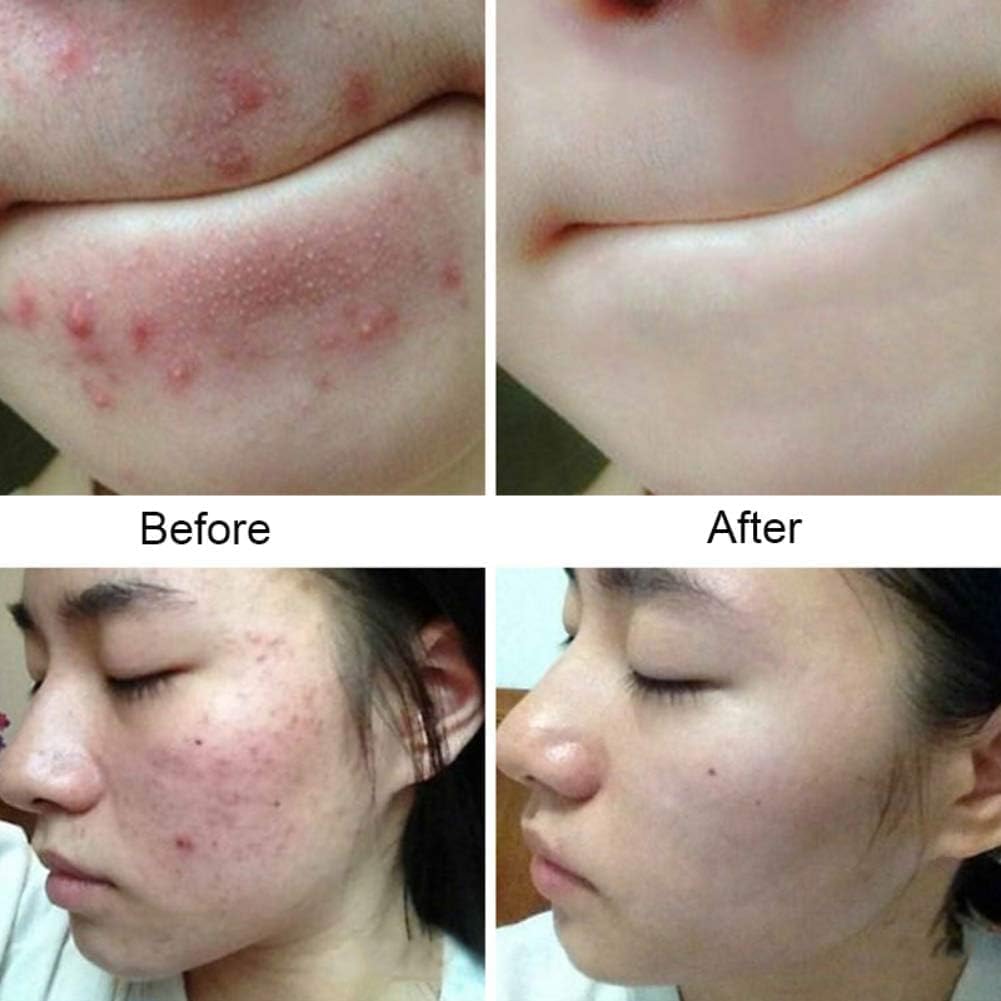 Anti Fungal & Anti Bacterial 2% Soap For Intensive Fungal Infections of The Skin | Helps Wash Away Ringworm, Jock Itch, Dry Skin, Dandruff, Acne | 75g - Image 3