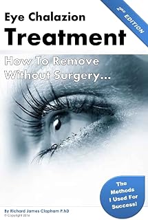 Eye Chalazion: How To Remove Without Surgery: My personal experience and the methods I used for success (Chalazions, Styes, Cysts: Eye treatment at home without surgery)