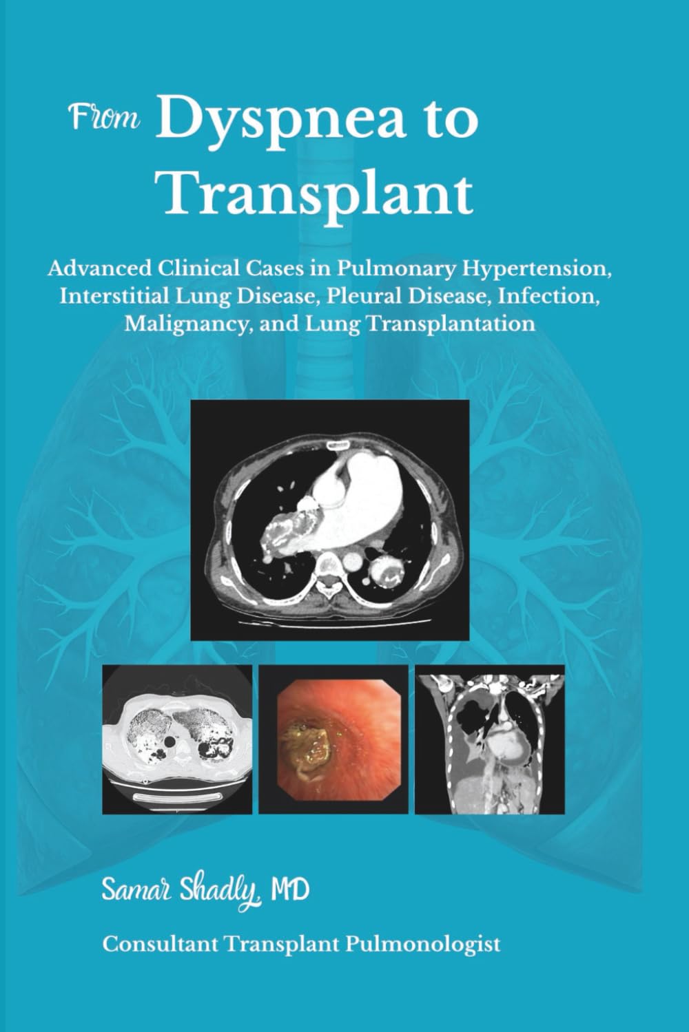 From Dyspnea to Transplant: Advanced Clinical Cases in Pulmonary Hypertension, Interstitial Lung Disease,Pleural Disease,Infection, Malignancy, and Lung Transplantation