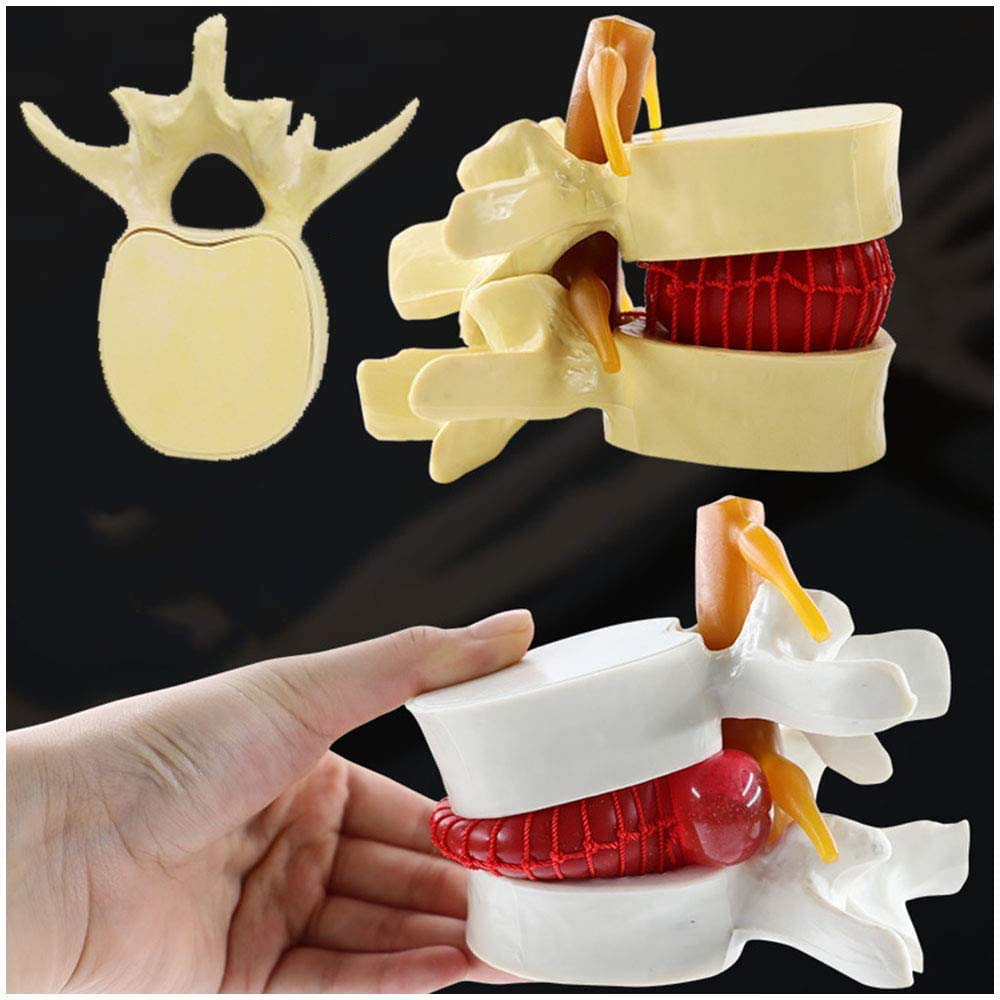 Sjdopulse A 1.5X Magnification Lumbar Model - Human Spine Model Human Lumbar Vertebrae Degenerative Lumbar Medical Teaching Model For Study Teaching Display (A)