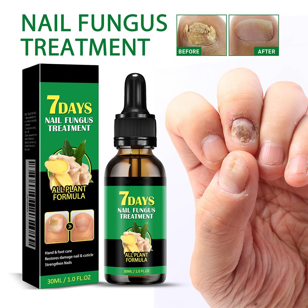 Siero per Unghie allo Zenzero da 30 ml, Siero per Unghie Rinforzante e Riparatore, Olio per Unghie allo Zenzero per Rafforzare le Unghie