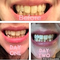 Vista 2 de Recarga de gel blanqueador dental 4X jeringas 44% peróxido de carbamida