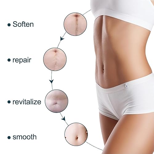 Miniatura 3 de Cinta de silicona de grado médico para cicatrices (rollo de 1.6 x 59 pulgadas, 4.9 ft), hojas de cicatrices de silicona para cesáreas, cirugía,