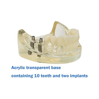 Dental RPD Removable Partial dentures Model Typodont lmplant Model